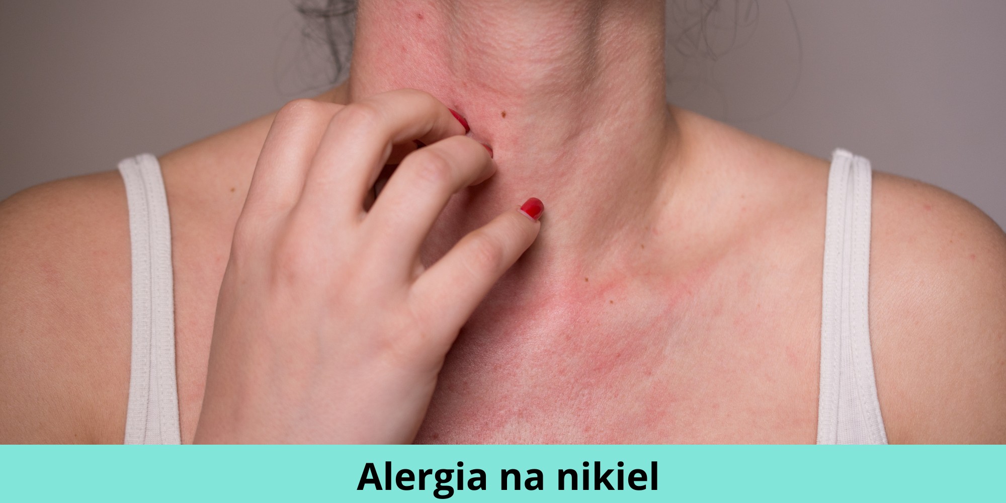 Alergia uczulenie na nikiel objawy jak leczyć