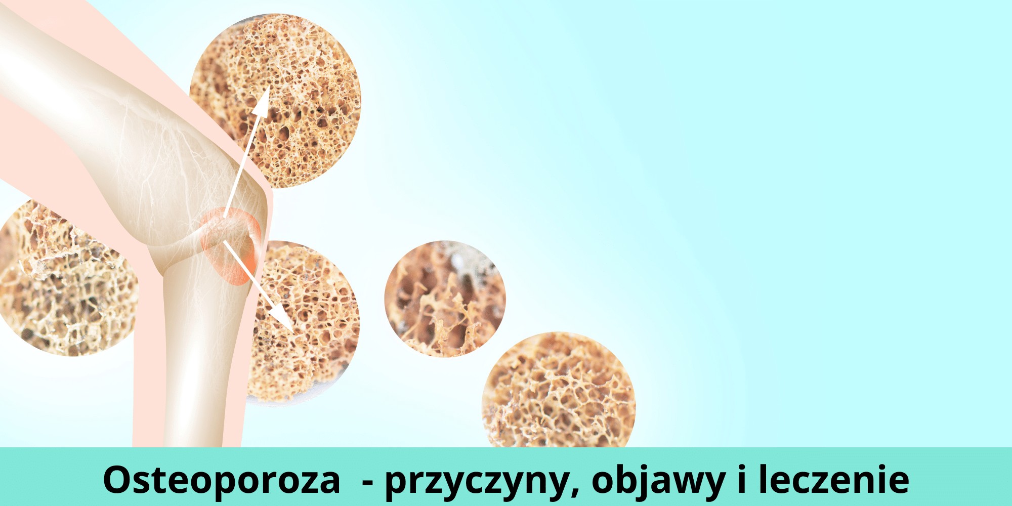 Osteoporoza Czym Jest Przyczyny Objawy I Leczenie 5690