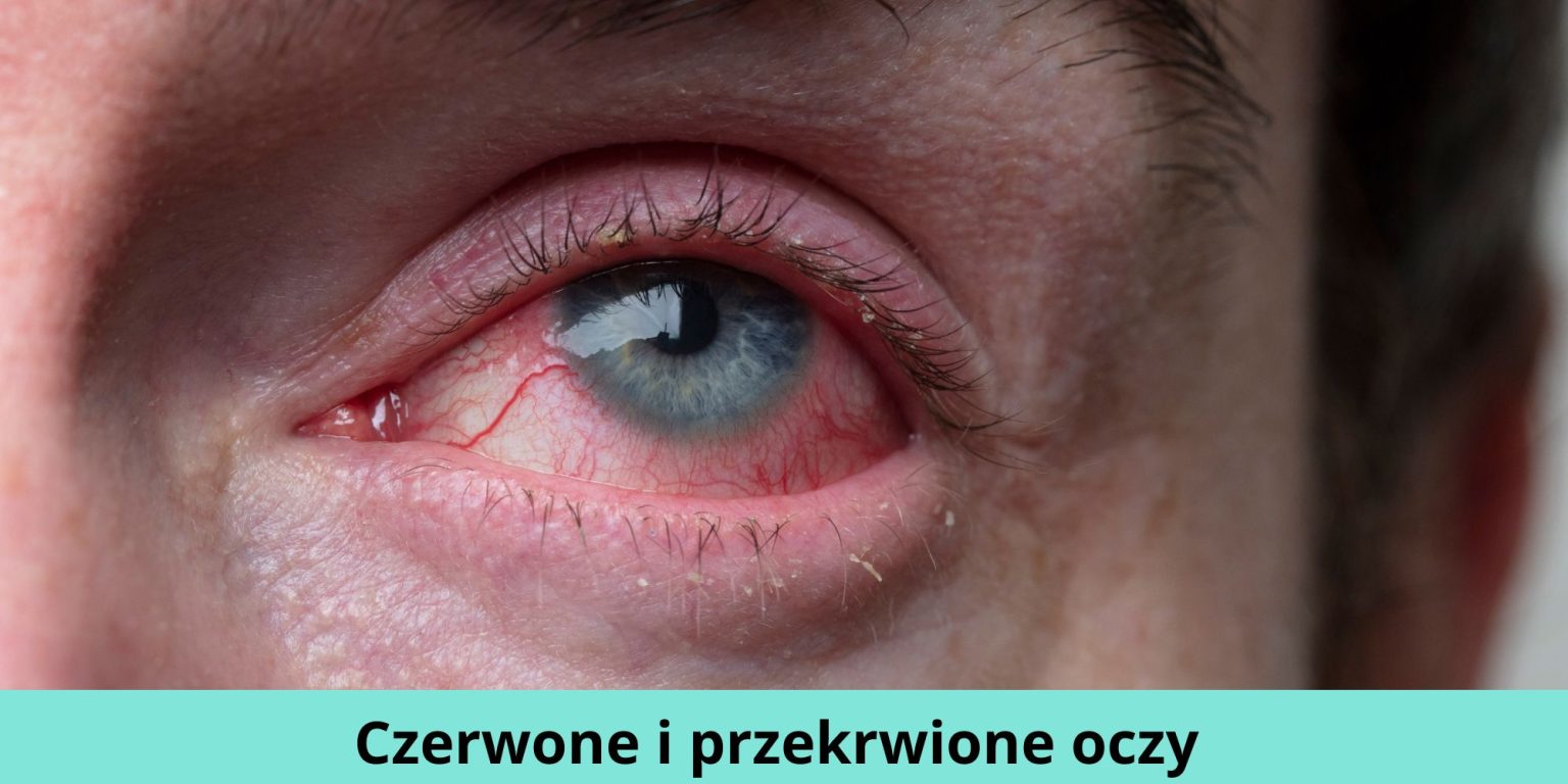Czerwone I Przekrwione Oczy Co Mogą Oznaczać Te Objawy 2716