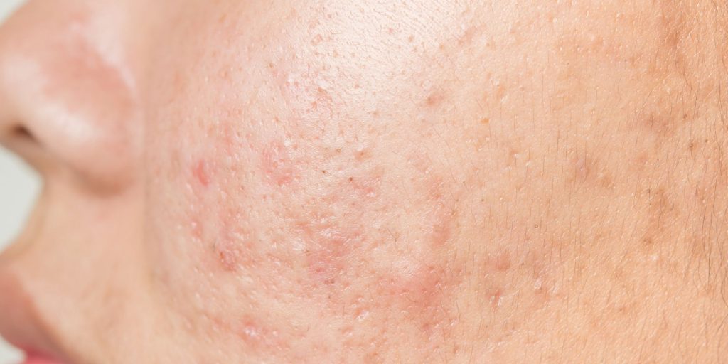 Trądzik neuropatyczny