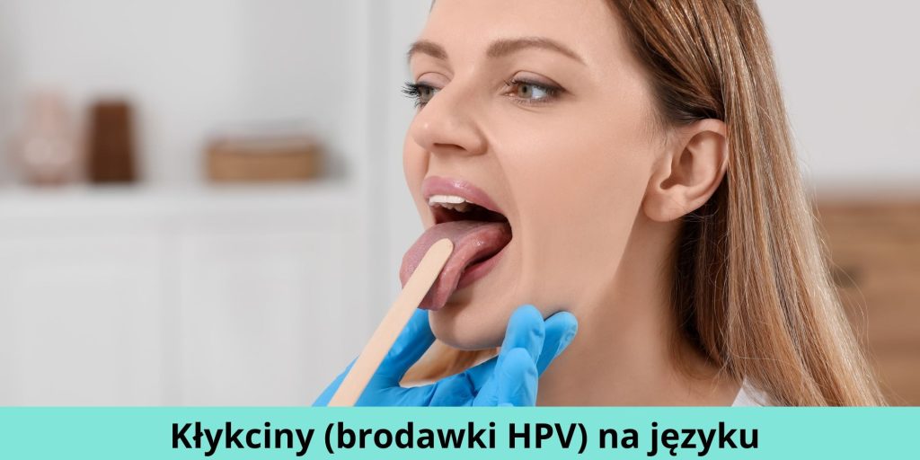 Kłykciny (brodawki HPV) na języku