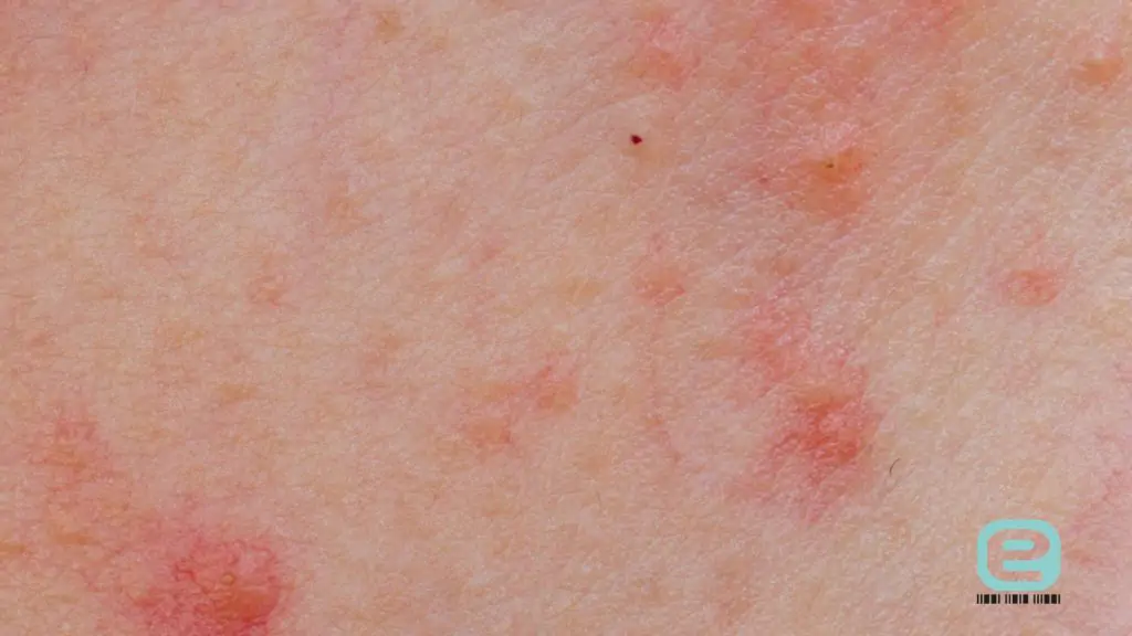 Rumień alergiczny