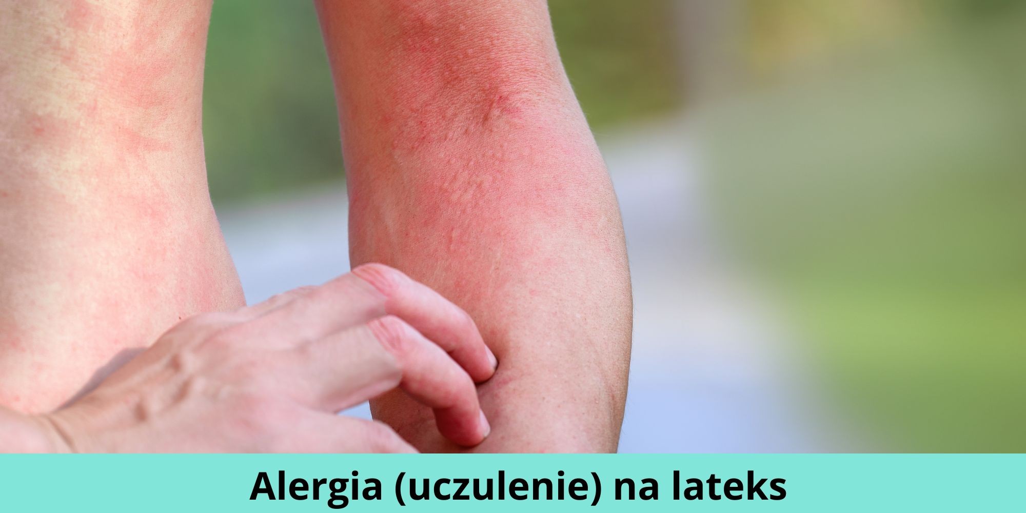Alergia Uczulenie Na Lateks Objawy Jak Rozpoznać Jak Leczyć 1931