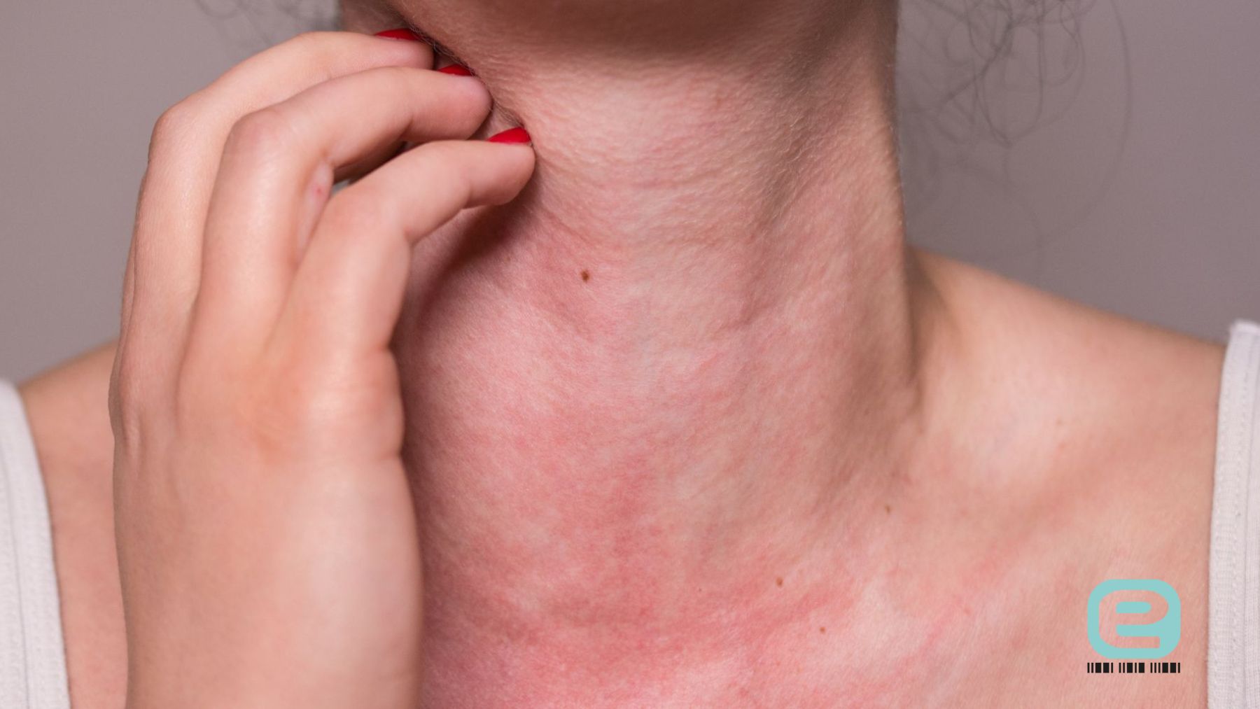 Alergia (uczulenie) na nikiel