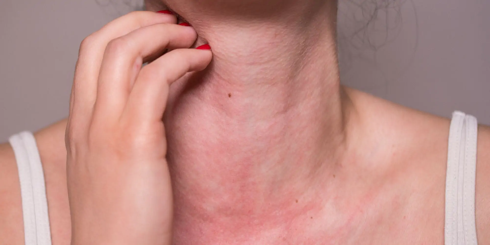 Alergia (uczulenie) na nikiel