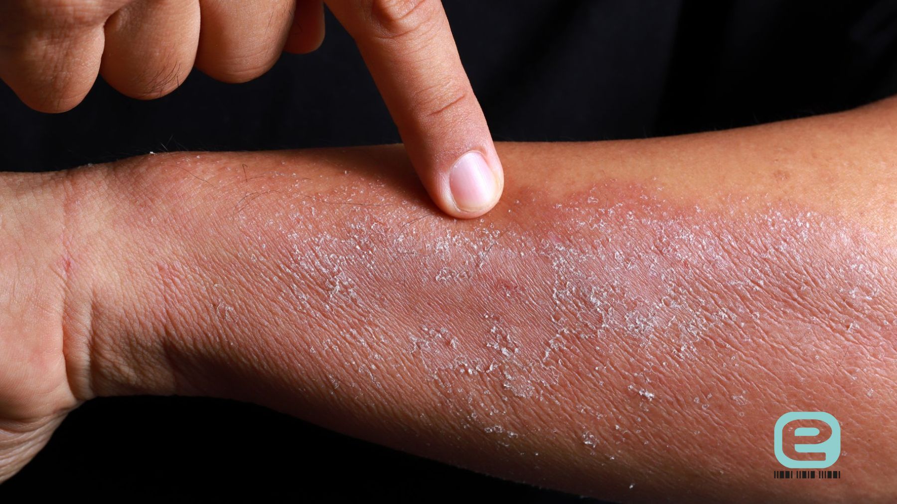 Uczulenie (alergia) skórna