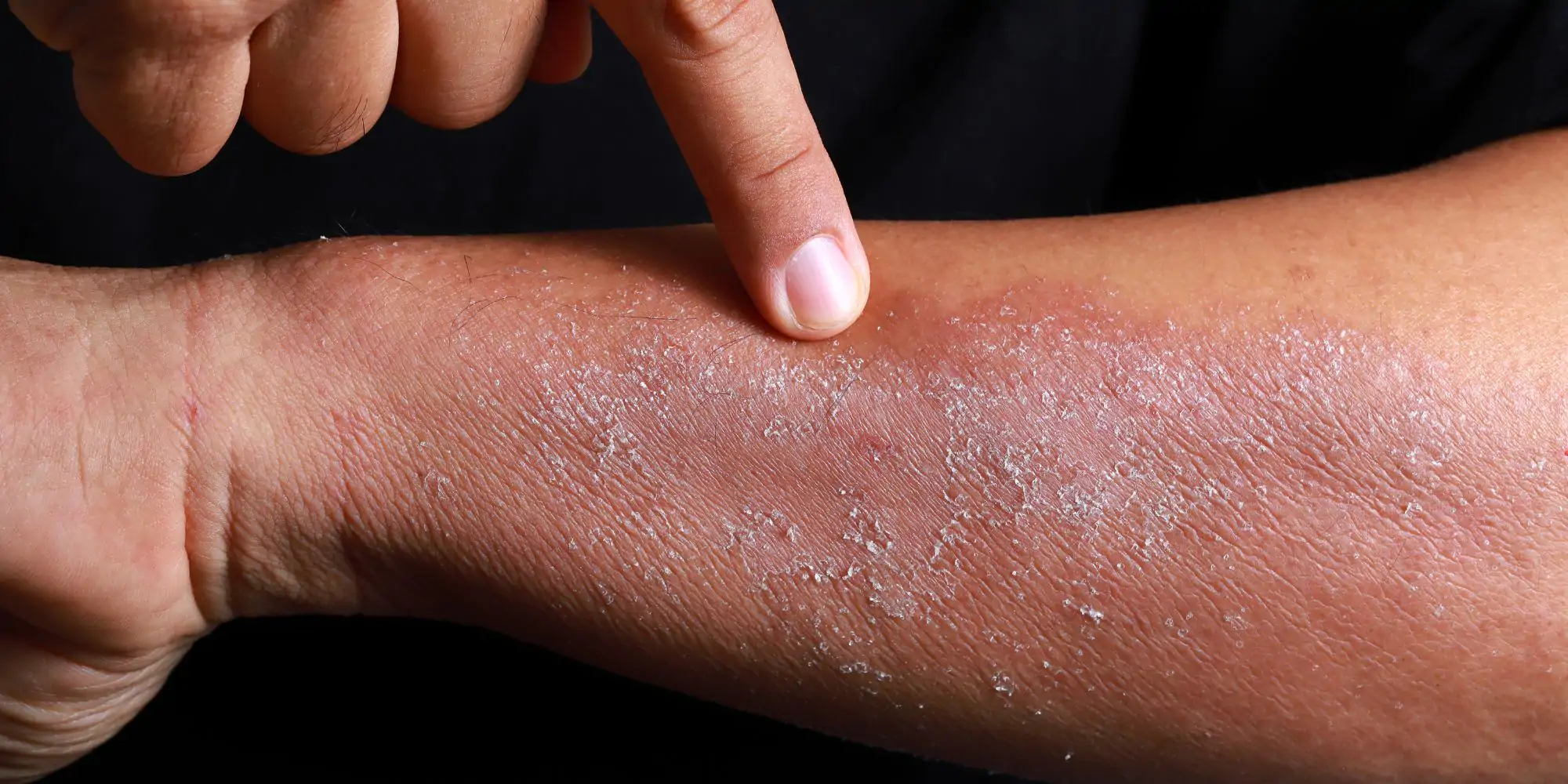 Uczulenie (alergia) skórna