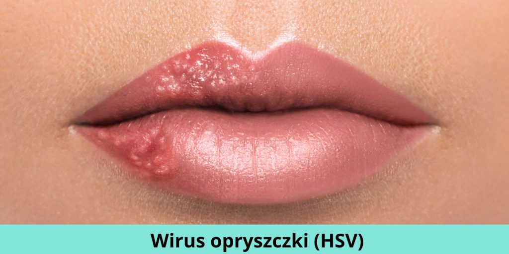 Wirus opryszczki (HSV)