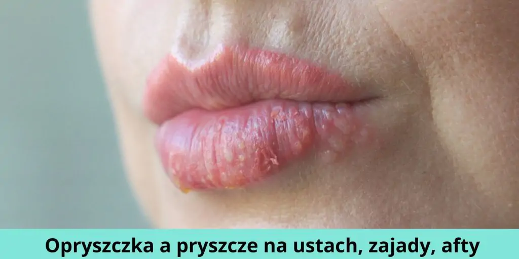 pryszcze na ustach