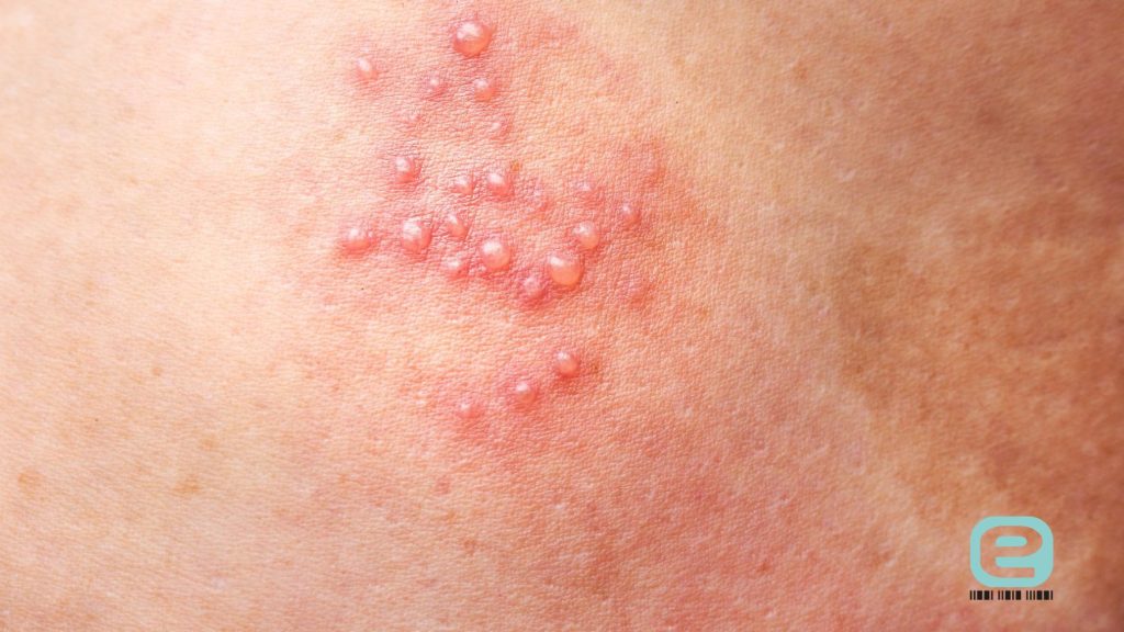 Opryszczka na twarzy