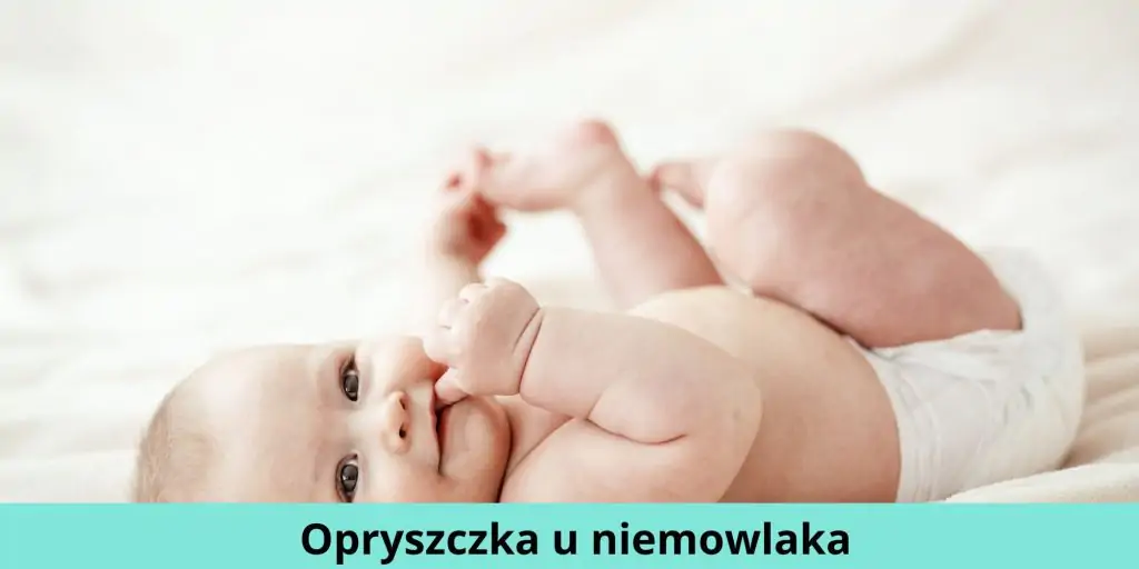 Opryszczka u niemowlaka