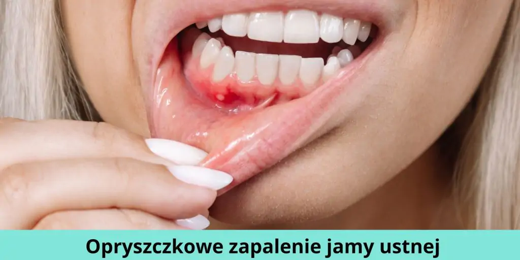 Opryszczkowe zapalenie jamy ustnej 