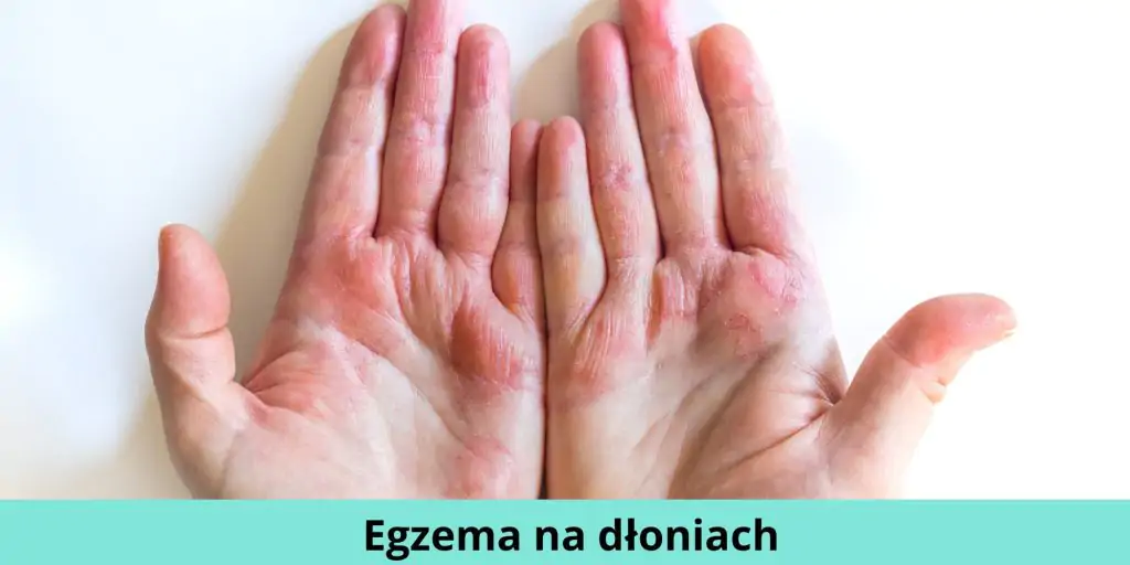 Egzema na dłoniach