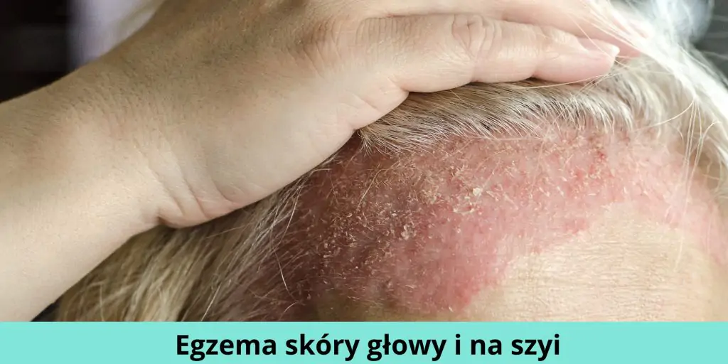 Egzema skóry głowy i na szyi