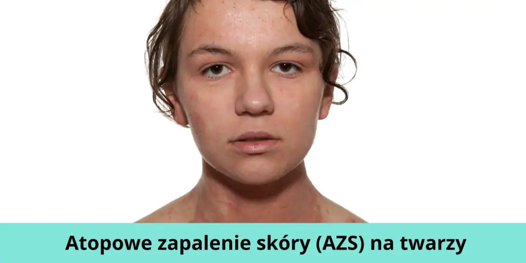 Atopowe zapalenie skóry (AZS) na twarzy