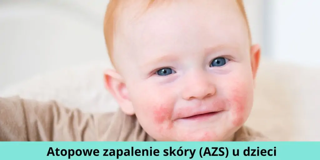 Atopowe zapalenie skóry (AZS) u dzieci