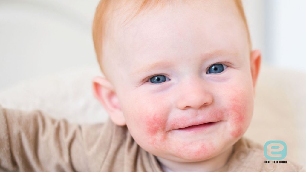 Atopowe zapalenie skóry (AZS) u niemowląt