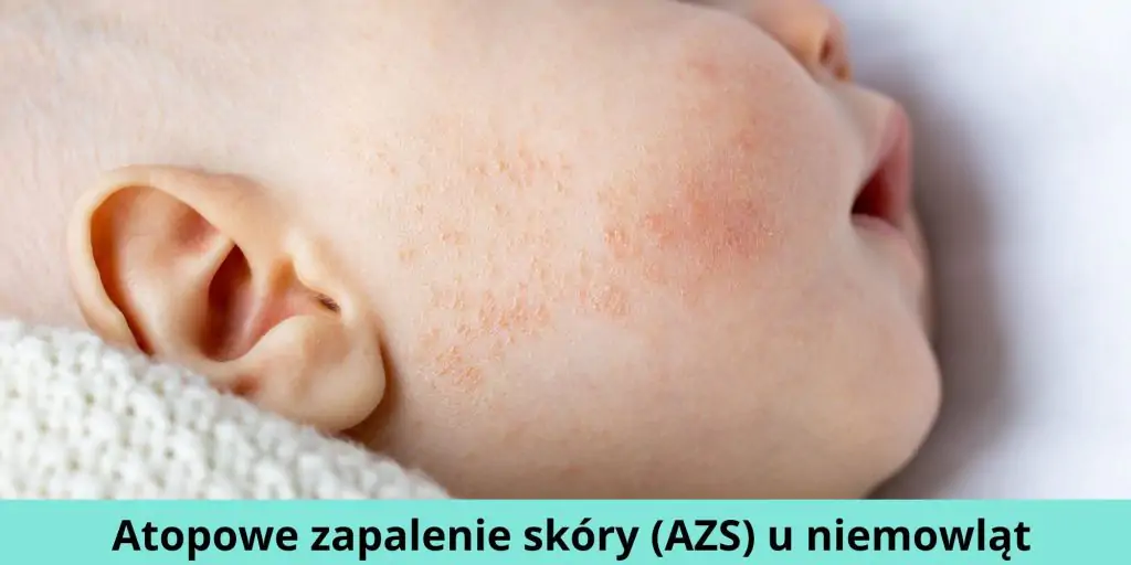 Atopowe zapalenie skóry (AZS) u niemowląt