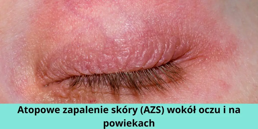 Atopowe zapalenie skóry (AZS) wokół oczu i na powiekach