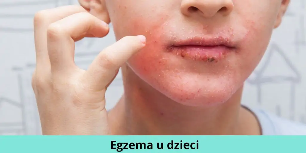 Egzema u dzieci