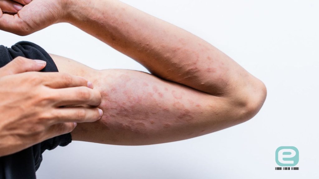 Swędzenie a atopowe zapalenie skóry (AZS) pod pachami