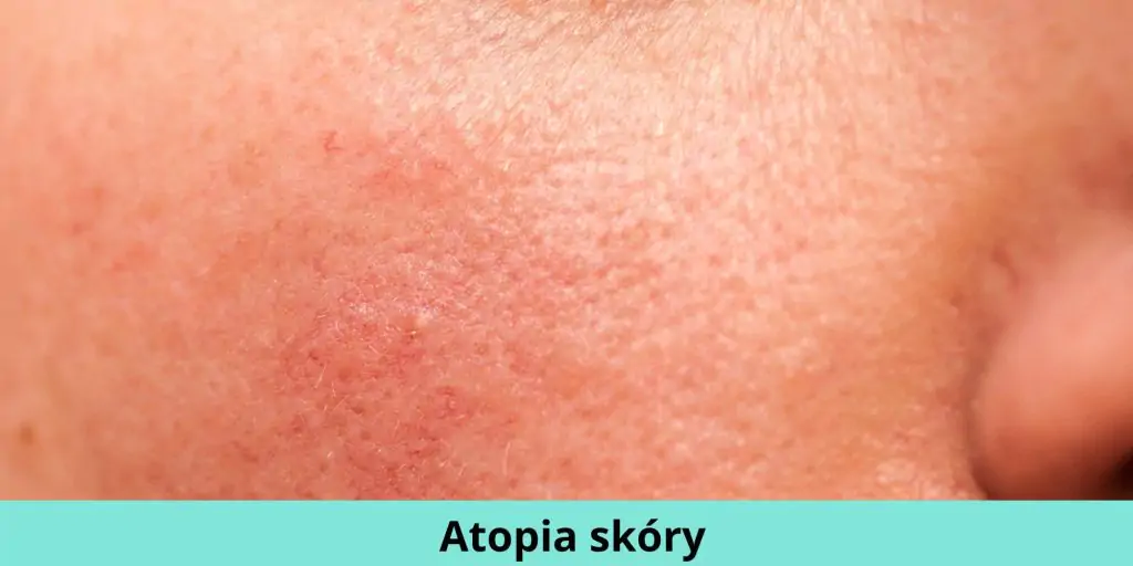 atopia skóry