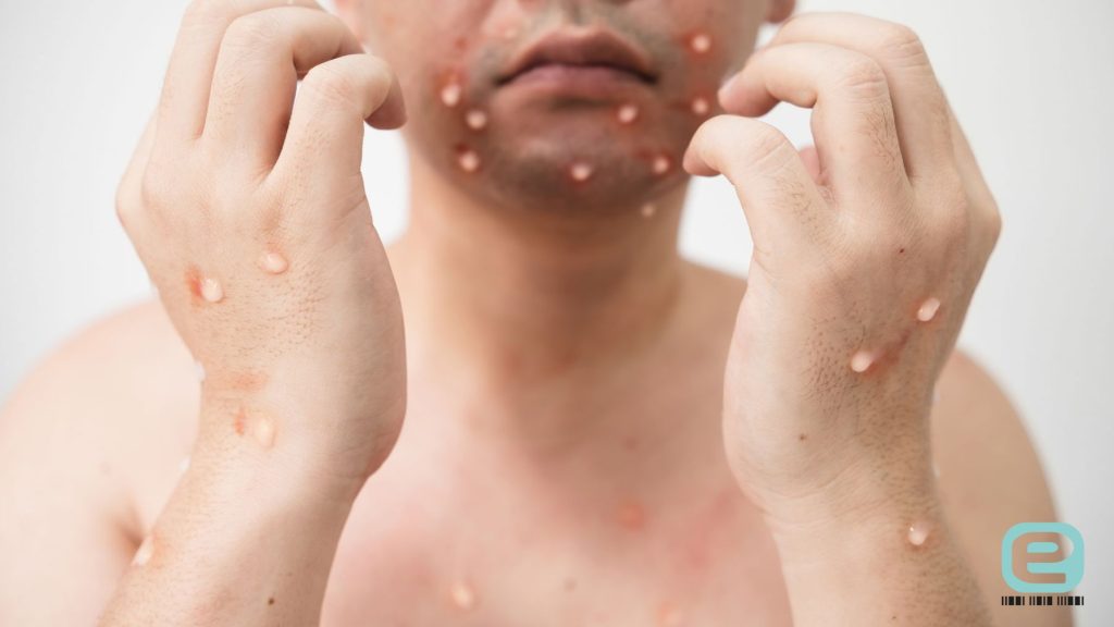 Łuszczyca krostkowa