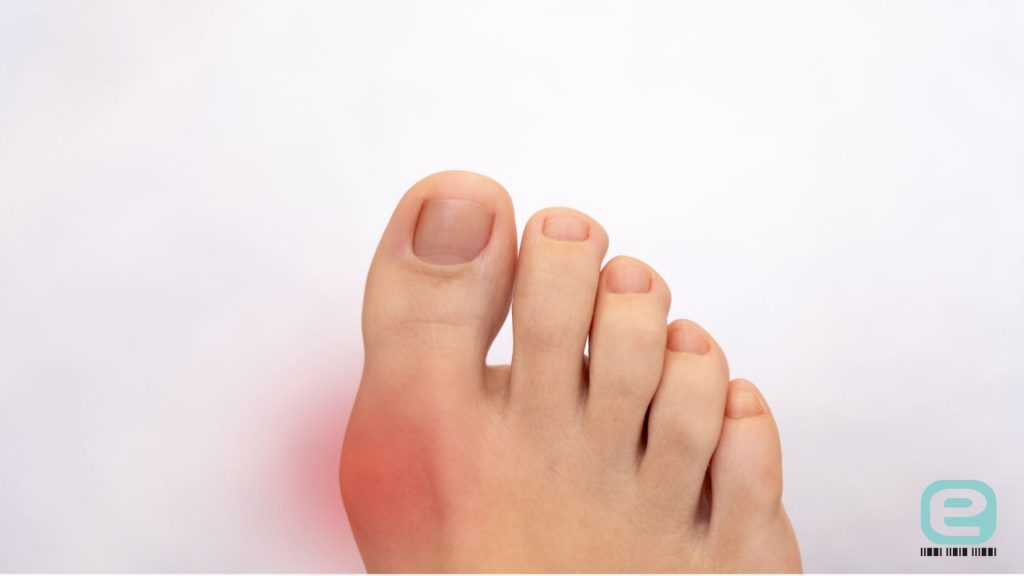 Ból dużego palca u stopy a dna moczanowa