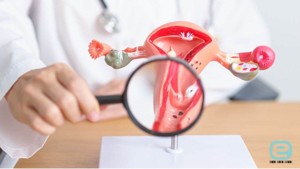 Endometrioza