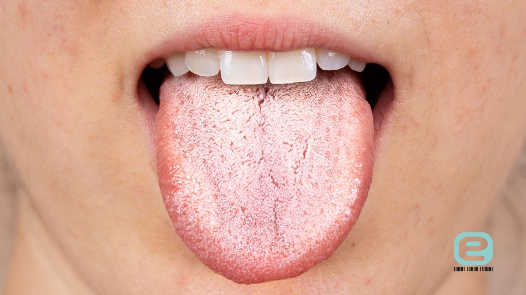 Grzybica (kandydoza) jamy ustnej i języka
