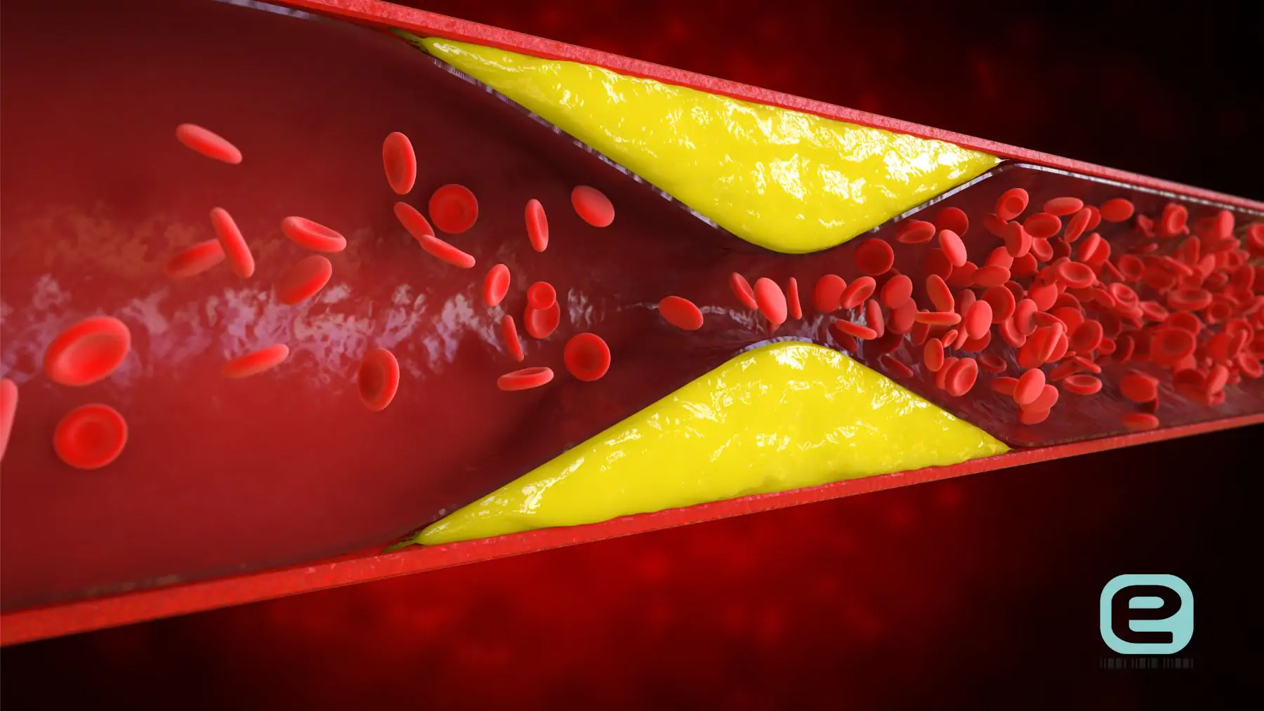 Hipercholesterolemia
