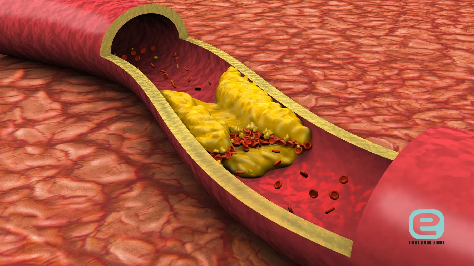 Wysoki cholesterol