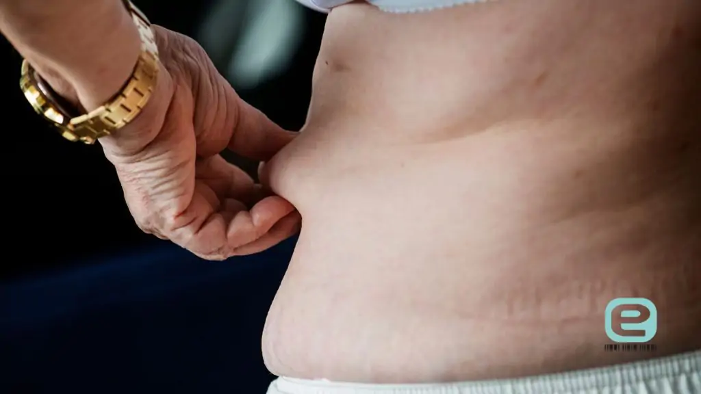 Lipodemia (obrzęk lipidowy)