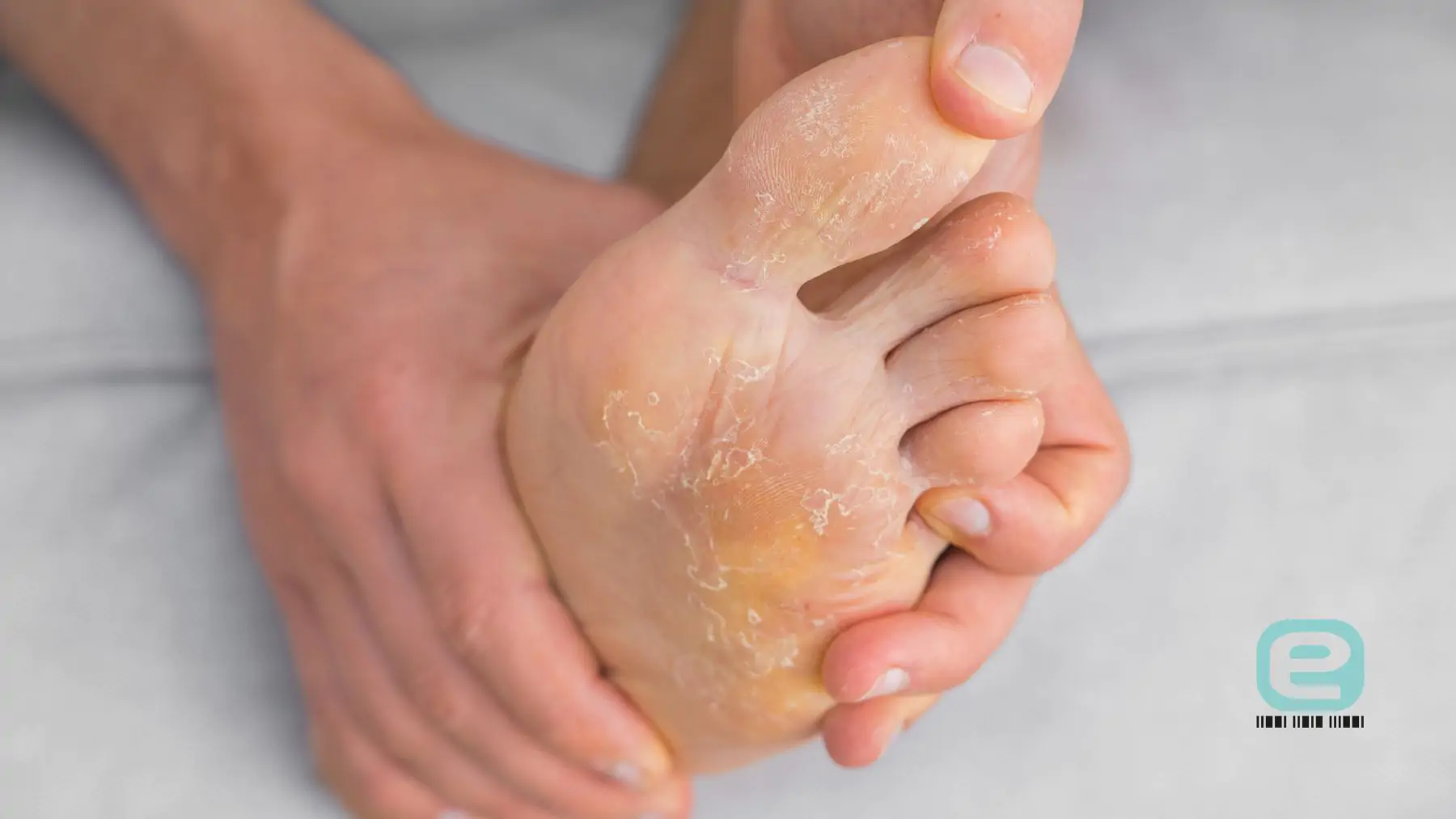 Grzybica złuszczająca (mokasynowa) stóp