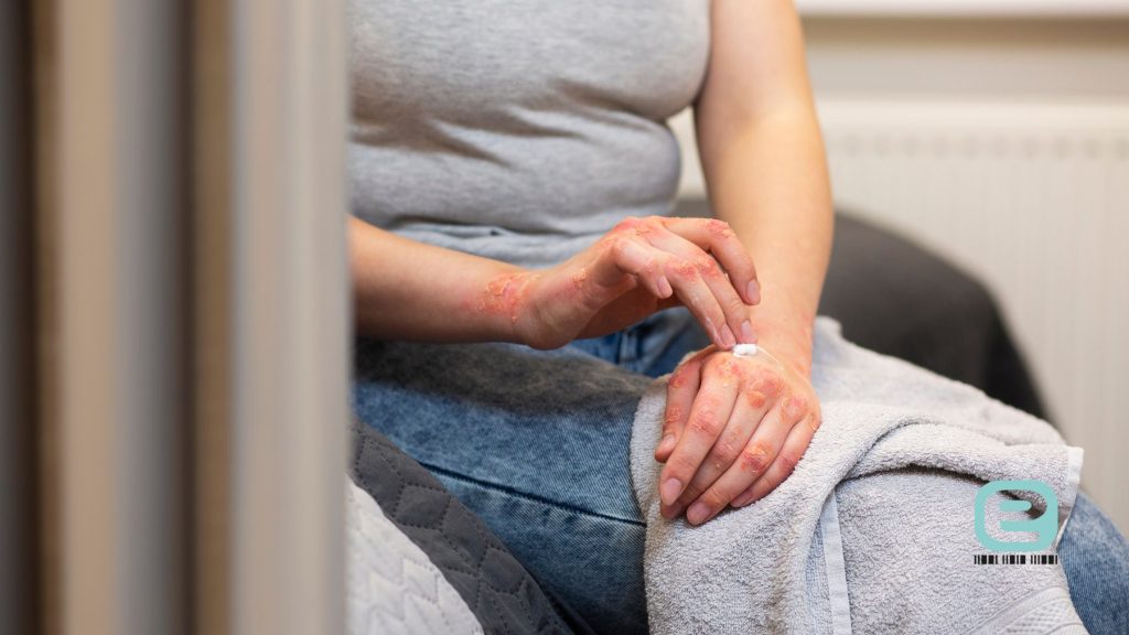 Zapalenie skóry leki