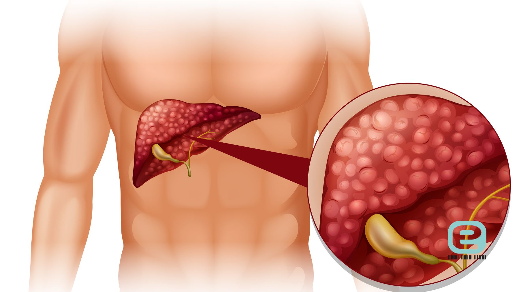 Stłuszczenie wątroby