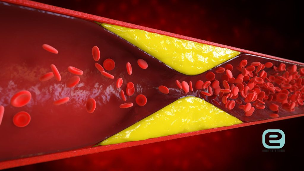 Hipercholesterolemia