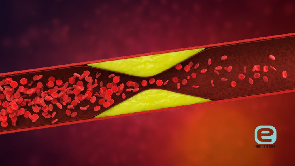 Hipercholesterolemia leczenie